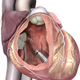 Illustration for article titled This Tiny Metal Pill Is the Smallest Pacemaker Ever Implanted